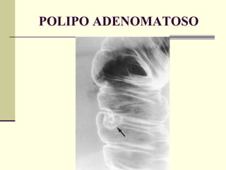 POLIPO ADENOMATOSO 
