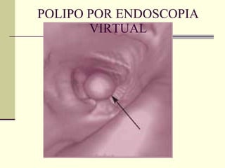 POLIPO POR ENDOSCOPIA VIRTUAL 