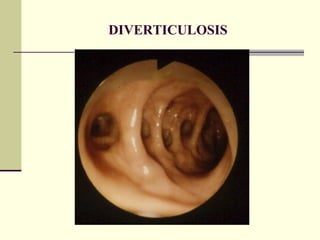 DIVERTICULOSIS 