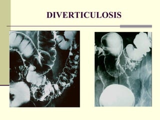 DIVERTICULOSIS 
