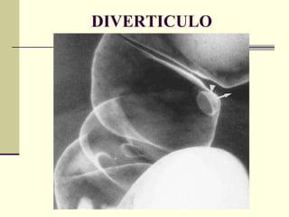 DIVERTICULO 