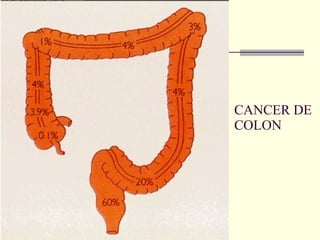 CANCER DE COLON 