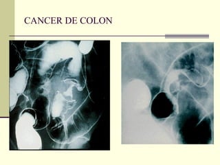 CANCER DE COLON 