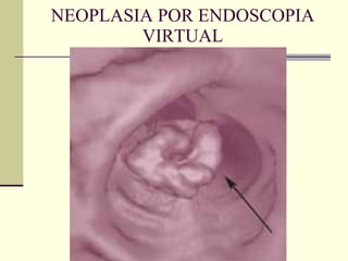 NEOPLASIA POR ENDOSCOPIA VIRTUAL 