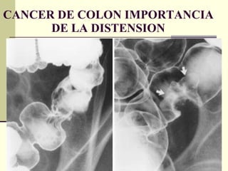 CANCER DE COLON IMPORTANCIA DE LA DISTENSION 