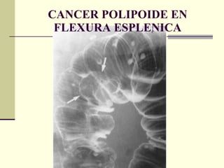 CANCER POLIPOIDE EN FLEXURA ESPLENICA 