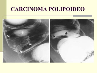 CARCINOMA POLIPOIDEO 