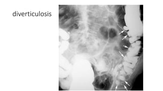 diverticulosis
 