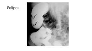 Polipos
 