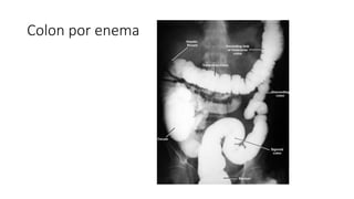 Colon por enema
 