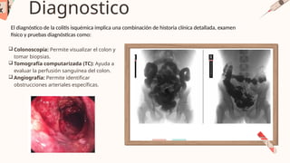 COLON ANATOMIA Y FISIOLOGIA DE INTESTINO PPTX colon-anatomia-y-fisiologia-de-intestino-pptx