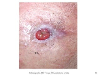 Felice Apicella, MD, Firenze 2003, colostomia sinistra F.A. 