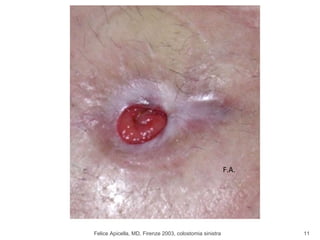 Felice Apicella, MD, Firenze 2003, colostomia sinistra F.A. 