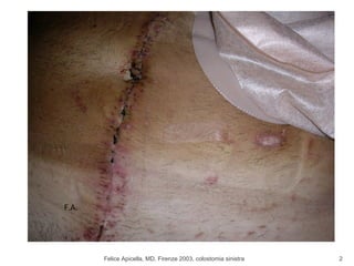 Felice Apicella, MD, Firenze 2003, colostomia sinistra F.A. 