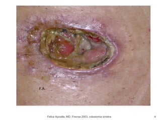 Felice Apicella, MD, Firenze 2003, colostomia sinistra F.A. 