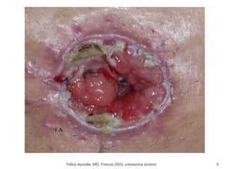 Felice Apicella, MD, Firenze 2003, colostomia sinistra F.A. 