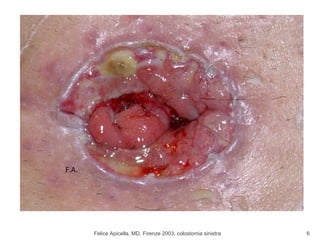 Felice Apicella, MD, Firenze 2003, colostomia sinistra F.A. 