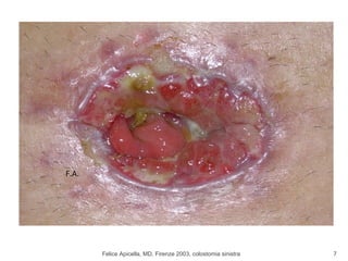 Felice Apicella, MD, Firenze 2003, colostomia sinistra F.A. 