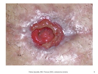 Felice Apicella, MD, Firenze 2003, colostomia sinistra F.A. 