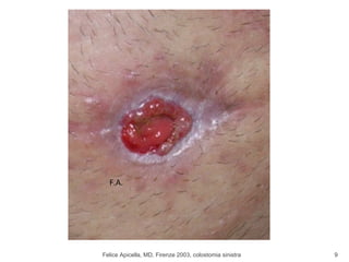 Felice Apicella, MD, Firenze 2003, colostomia sinistra F.A. 