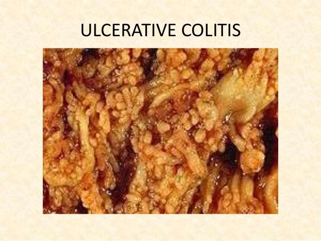 Purinethol Ulcerative Colitis