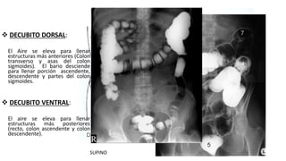 SUPINO 
 DECUBITO DORSAL: 
El Aire se eleva para llenar 
estructuras más anteriores (Colon 
transverso y asas del colon 
sigmoides). El bario desciende 
para llenar porción ascendente, 
descendente y partes del colon 
sigmoides. 
 DECUBITO VENTRAL: 
El aire se eleva para llenar 
estructuras más posteriores 
(recto, colon ascendente y colon 
descendente). 
 