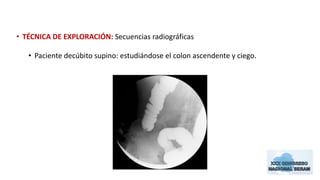 • TÉCNICA DE EXPLORACIÓN: Secuencias radiográficas 
• Paciente decúbito supino: estudiándose el colon ascendente y ciego. 
 
