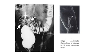 Pólipo pediculado 
(flechas) que se observa 
en el colon sigmoides 
distal 
 