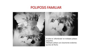 POLIPOSIS FAMILIAR 
El colon es 'alfombrado' en múltiples pólipos 
pequeños. 
Múltiples pólipos son claramente evidentes 
(puntas de flecha 
 