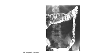 Sd. poliposis colónica 
 