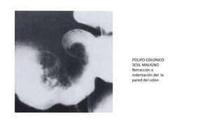POLIPO COLONICO 
SESIL MALIGNO 
Retracción o 
indentación del la 
pared del colon 
 