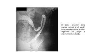 El colon proximal tiene 
mucosa normal y el patrón 
haustras mientras que la distal 
segmento sin rasgos y 
anormalmente reducido. 
 
