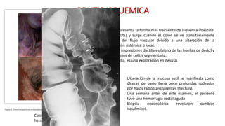 COLITIS ISQUEMICA 
Colon transverso edema y 
hemorragia 
La CI representa la forma más frecuente de isquemia intestinal 
(el 60-70%) y surge cuando el colon se ve transitoriamente 
privado del flujo vascular debido a una alteración de la 
circulación sistémica o local. 
mostrar impresiones dactilares (signo de las huellas de dedo) y 
otros signos de colitis segmentaria. 
Hoy en día, es una exploración en desuso. 
Ulceración de la mucosa sutil se manifiesta como 
úlceras de bario llena poco profundas rodeadas 
por halos radiotransparentes (flechas). 
Una semana antes de este examen, el paciente 
tuvo una hemorragia rectal aguda 
biopsia endoscópica revelaron cambios 
isquémicos. 
 