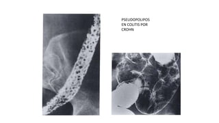 PSEUDOPOLIPOS 
EN COLITIS POR 
CROHN 
 