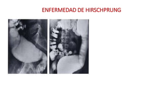 ENFERMEDAD DE HIRSCHPRUNG 
 
