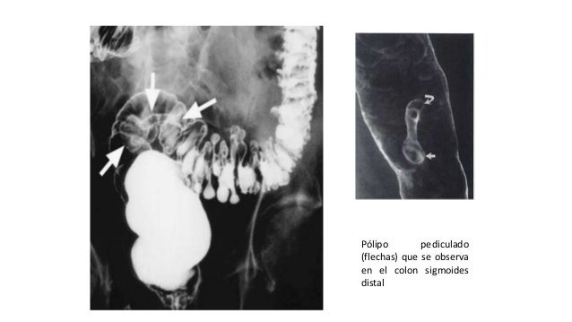doble contraste en radiologia doble contraste en radiologia