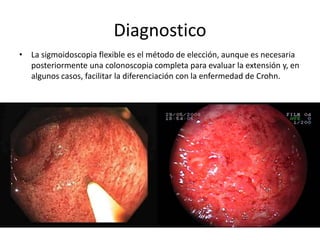 Diagnostico
• La sigmoidoscopia flexible es el método de elección, aunque es necesaria
posteriormente una colonoscopia completa para evaluar la extensión y, en
algunos casos, facilitar la diferenciación con la enfermedad de Crohn.
 
