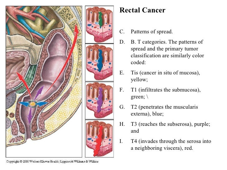 colon and rectal cancer colon cancer tumor size