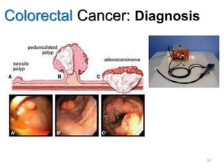 Colorectal Cancer: Diagnosis
50
 