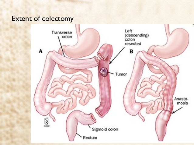 Partial Colectomy Vs. Partial Colectomy With Ileocolostomy – TWPFPC