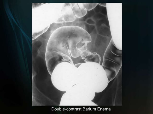 Colon Cancer PPT
