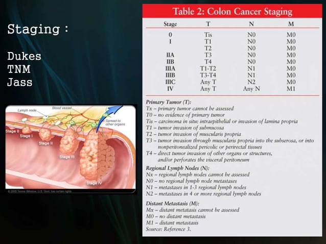 Colon Cancer PPT