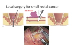 Local surgery for small rectal cancer
©Dr Winston
 