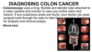 Colon Cancer.pptx