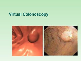 Virtual Colonoscopy
 