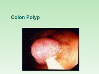 Colon Polyp
 