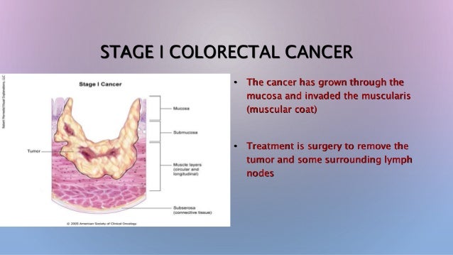 colon cancer colon cancer mass size