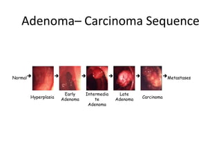 Adenoma– Carcinoma Sequence

Normal Metastases
   
Hyperplasia
Early
Adenoma
Intermedia
te
Adenoma
Late
Adenoma
Carcinoma

 