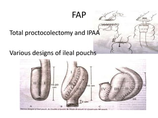 FAP
Total proctocolectomy and IPAA
Various designs of ileal pouchs
 