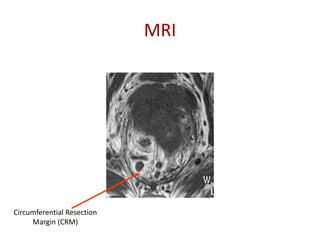 MRI
Circumferential Resection
Margin (CRM)
 